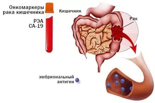 Сдать онкомаркер на рак кишечника. Раково эмбриональный антиген механизм действия. рэа онкомаркер антигены. онкомаркеры кишечника и прямой кишки. маркеры опухоли кишечника.