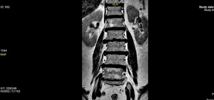 Мрт мрт поясничного-крестцового отдела позвоночника. Снимок мрт пояснично крестцового отдела позвоночника. Мрт пояснично-крестцового отдела позвоночника фото. Пример мрт пояснично крестцового отдела позвоночника.
