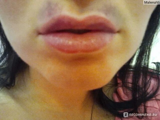 Увеличение / Аугментация губ с помощью препарата гиалуроновой кислоты "Увеличи