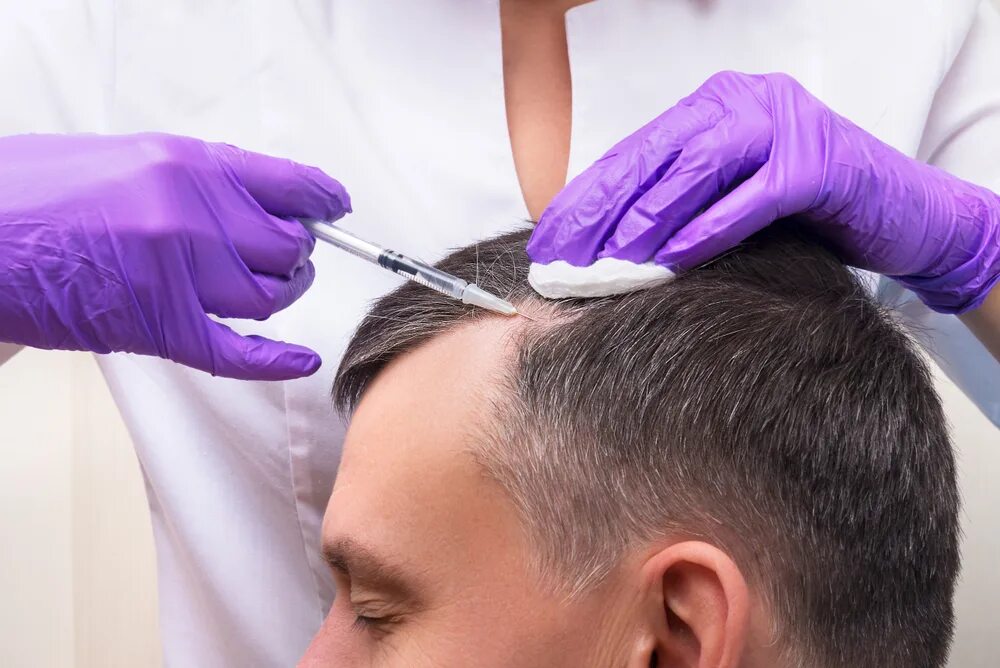 Укрепление волос мужчинам. Мезотерапия волос мужчин. Мезотерапия волосистой части головы. Инъекции для волос.