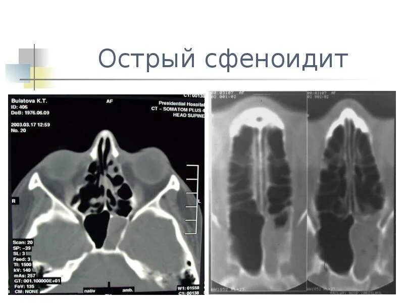 Сфеноидит операция. Экссудативный сфеноидит на кт. Клиновидная пазуха рентген. Левосторонний катаральный сфеноидит.