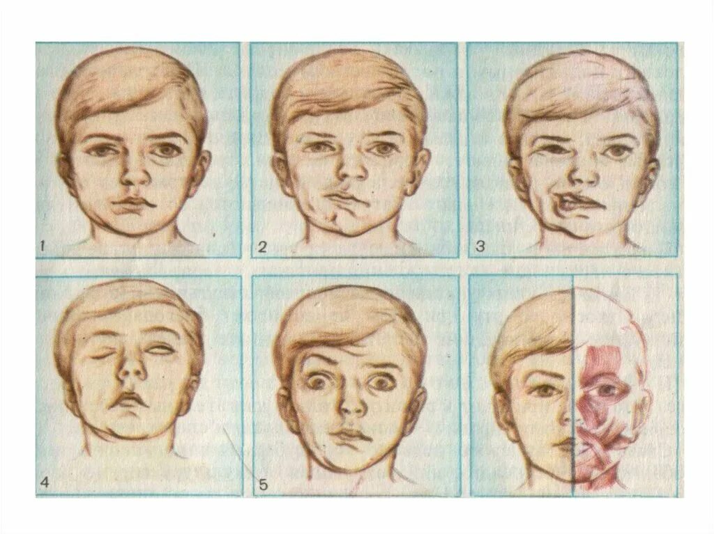 Сглажена носогубная складка. Паралич черепных нервов. Парез черепно мозговых нервов. Парез 3 и 4 пары черепных нервов. Парез 3 пары черепно мозговых.