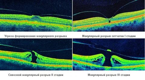 Макула разрыв операция