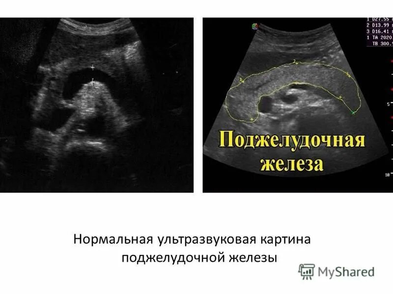 диагностика желчнокаменной болезни узи. эхограмма желчного пузыря. дискинезия желчного пузыря узи. желчный не виден на узи. ультрасонография желчного пузыря камни.