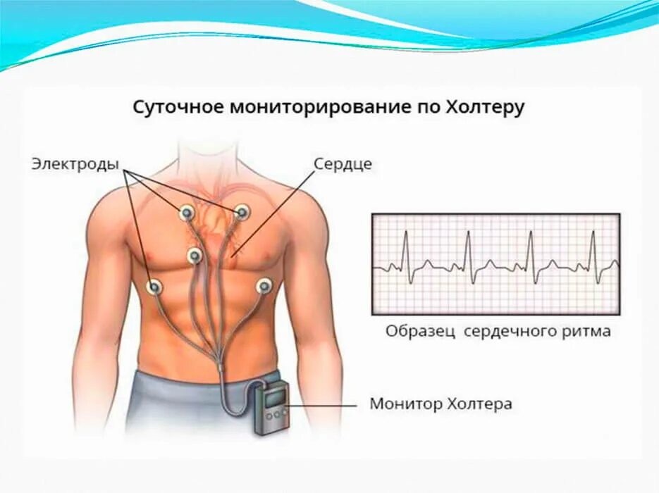 Холтеровское мониторирование сердца как проводится. Суточное мониторирование экг (холтер-мониторинг). холтер экг постановка электродов. холтер схема прибора. холтер экг наложение электродов.