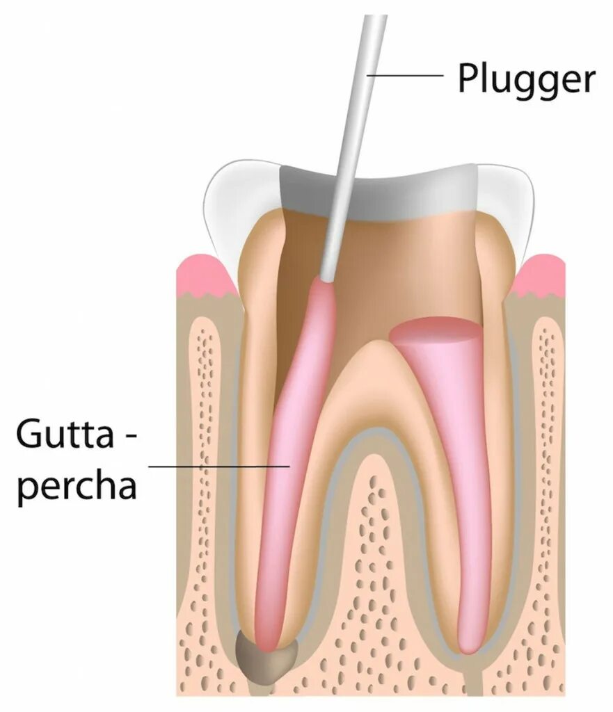 Root canal. Гуттаперча в стоматологии. Штифты в стоматологии для пломбирования.