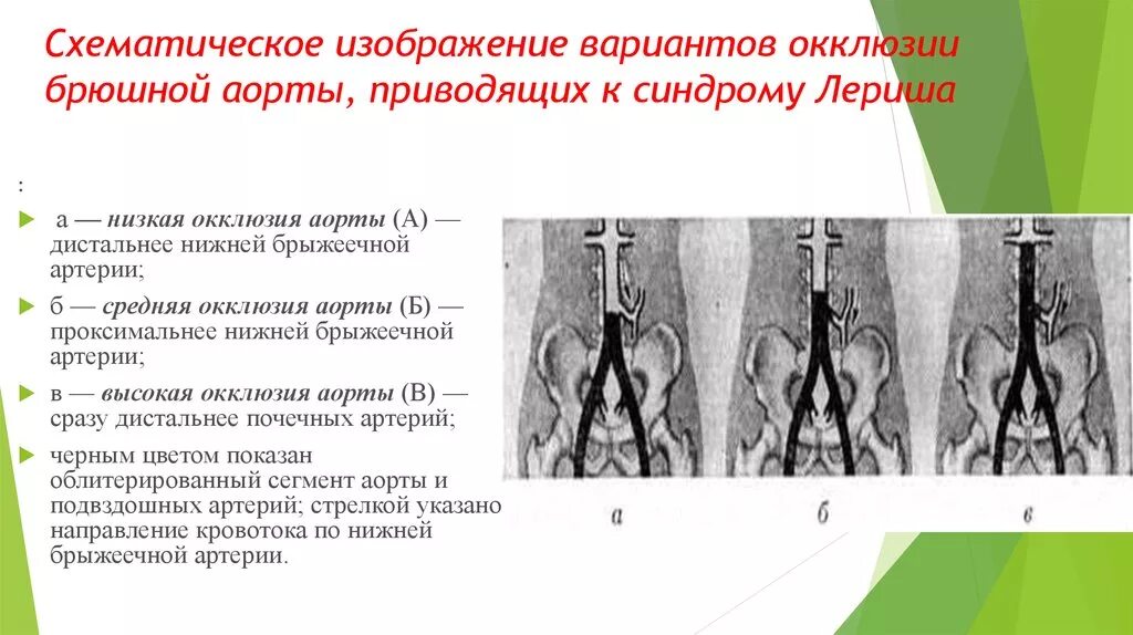 Атеросклероз брюшной аорты. Атеросклероз синдром лериша. синдром лериша подвздошной артерии. осложнение атеросклероза синдром лериша.