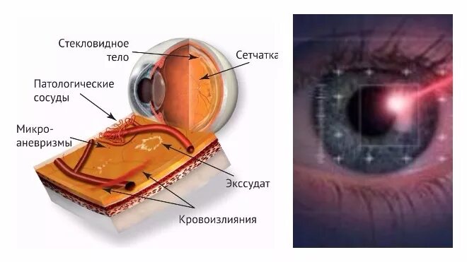 Фокальная лазерная коагуляция сетчатки глаза. Отграничительная лазеркоагуляция сетчатки глаз. Отслойка сетчатки лазерная коагуляция. Периферическая лазеркоагуляция сетчатки глаза.