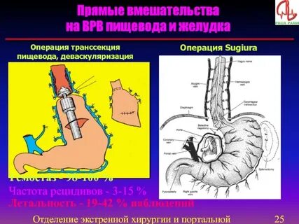 Операция на пищеводе и желудке