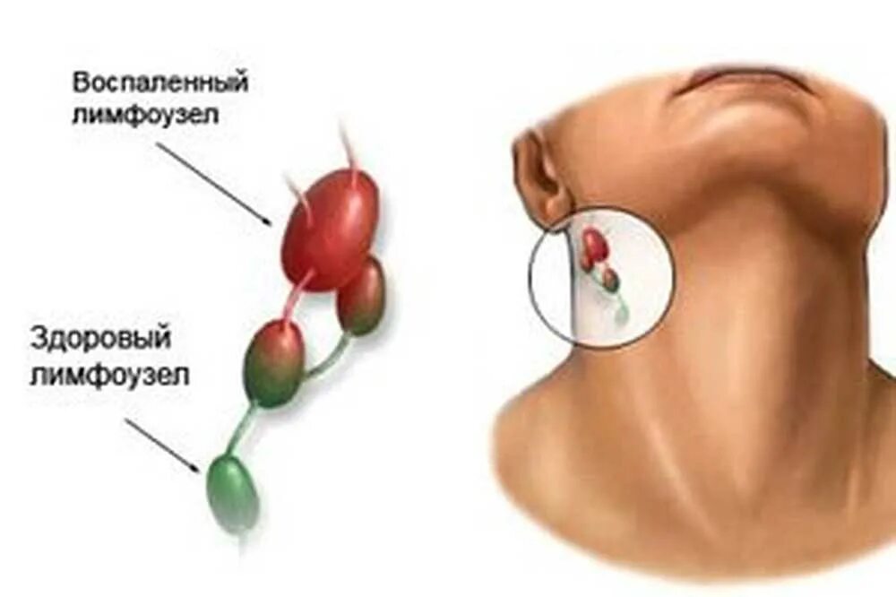 Лимфоузлы можно при раке