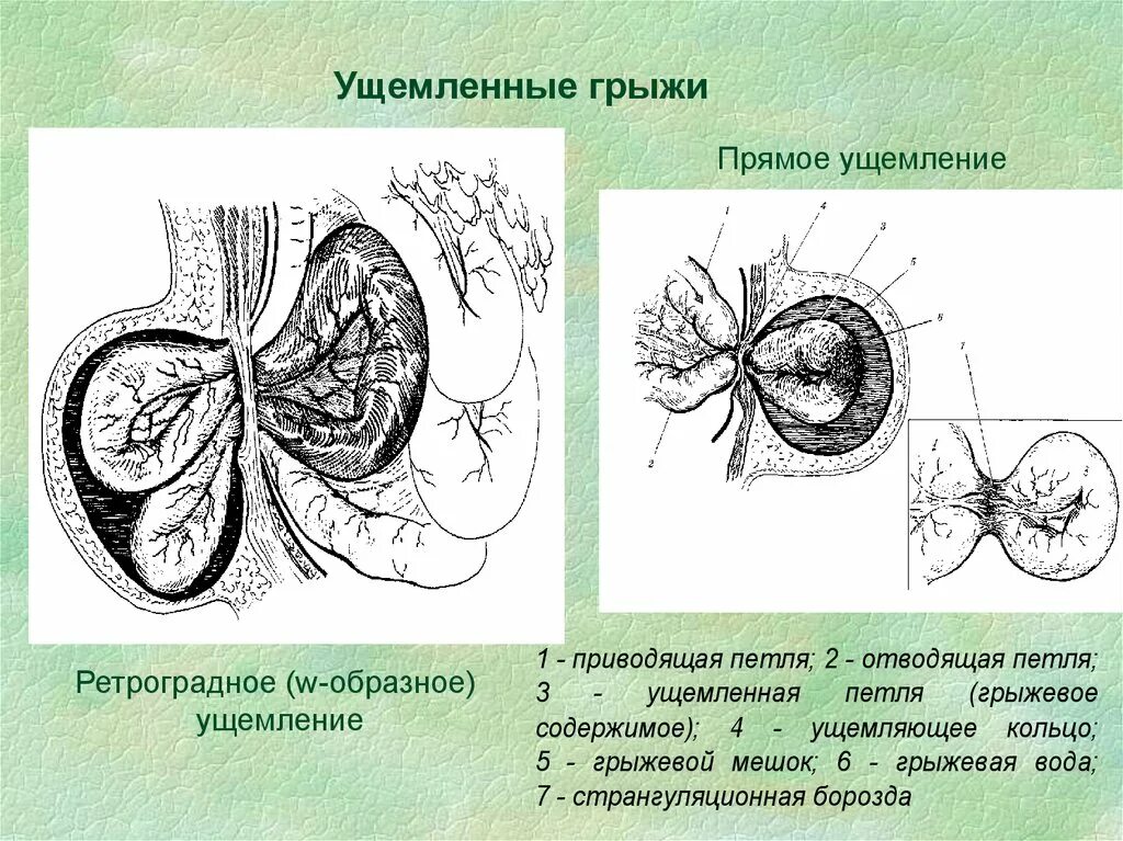 Ущемленная брюшной грыжа. Анатомия ущемленной грыжи. Ретроградное ущемление грыжи.