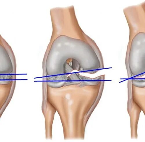 Разрыв 3 степени. Разрыв мениска коленного сустава степени. Резекция медиального мениска. Разрыв мениска операция.