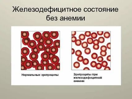 Эритроциты при анемии