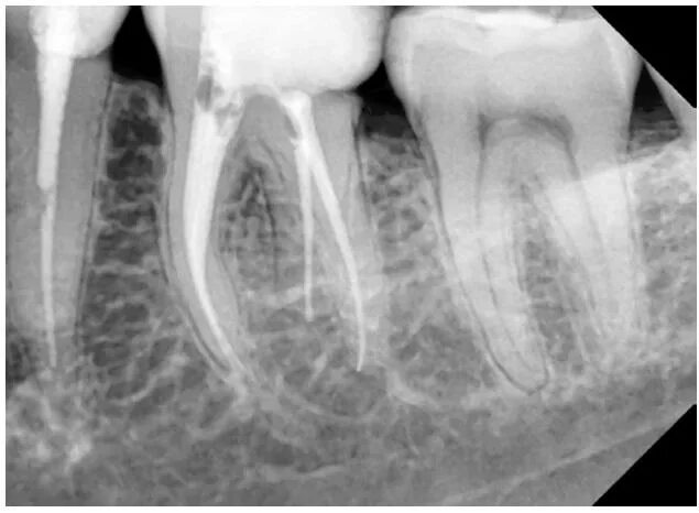 Временное пломбирование каналов зуба. Обтурация корневого канала рентген. Гуттаперча в канале рентген.