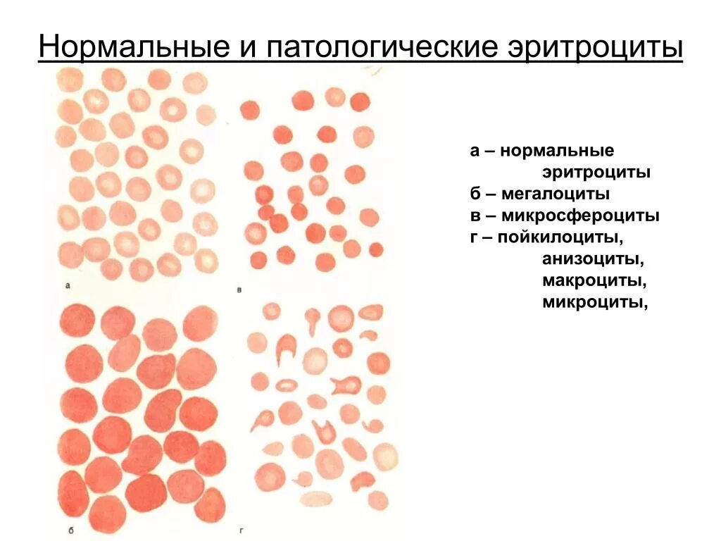 Патологические формы эритроцитов при различных анемиях. Патологические формы эритроцитов периферической крови. Микроцитоз анизоцитоз пойкилоцитоз. Эритроциты при анемии.