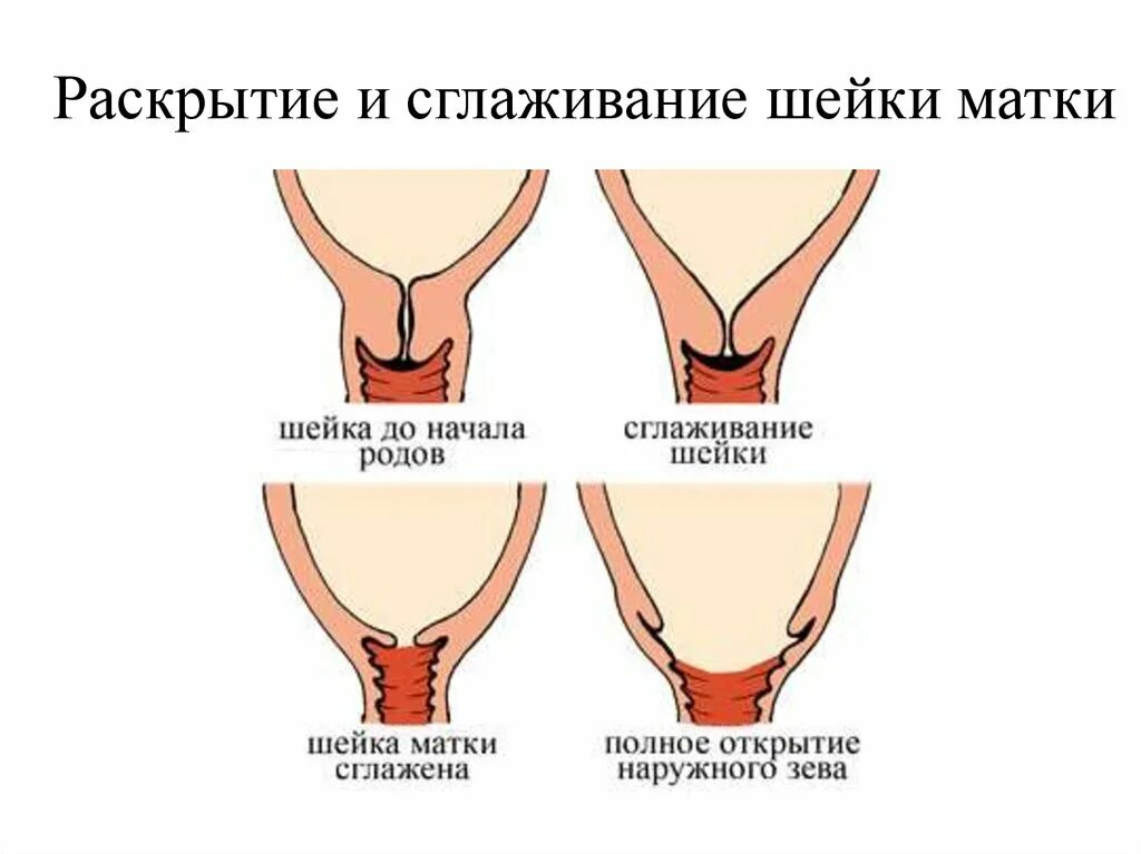Слизистая пробка беременность. Раскрытие матки. Раскрытие матки 1 палец при беременности. Слизислизистая пробка. Как выглядит шейка перед родами.