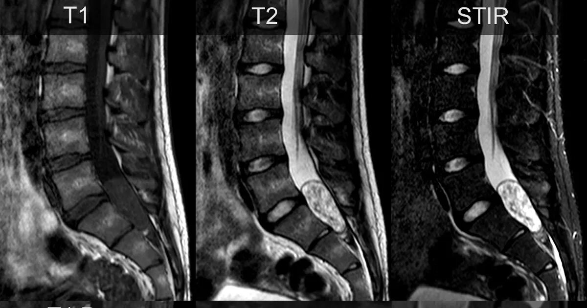 Эпендимома терминальной нити. Шваннома позвоночника кт. Невринома позвоночника мрт. Эпендимома конского хвоста спинного мозга.