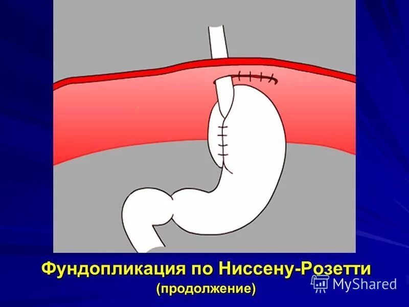 Грыжа пищевода цена. Фундопластика по Ниссену. Фундопликация по Ниссену Розетти. Операция Ниссена фундопликация. Схема фундопликации по Ниссену.