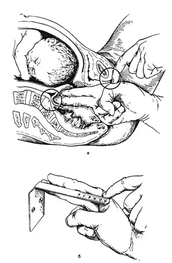 Пальцевое исследование шейки матки. Диагональная конъюгата в акушерстве. Измерение диагональной конъюгаты. Диагональная конъюгата в акушерстве измерение. Расширение таза при беременности