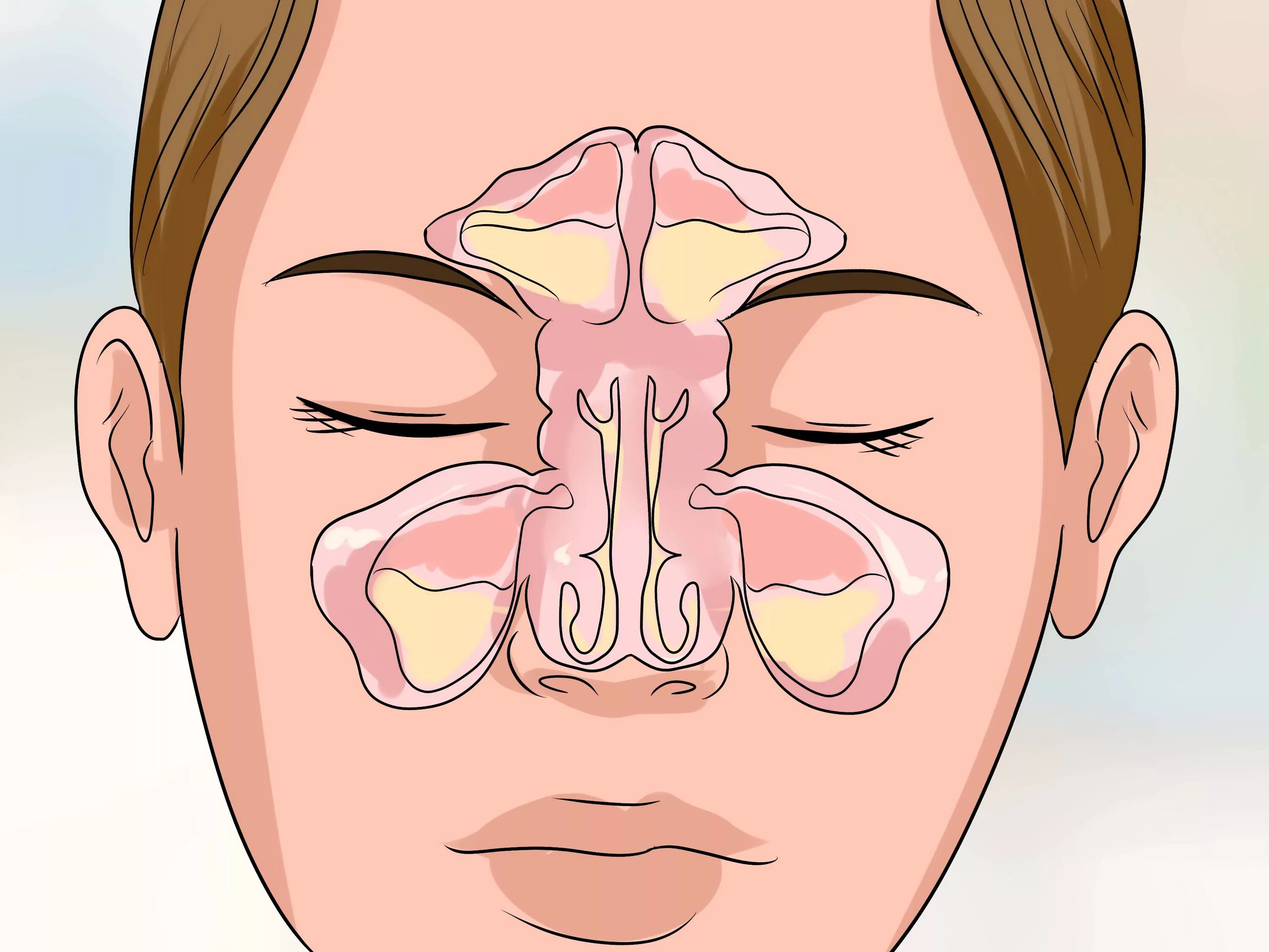 Почему сопли пахнут. Гайморовы пазухи гайморит. Пазухи носа анатомия гайморит. Синусит верхнечелюстной пазухи. Острый Гнойный пансинусит.