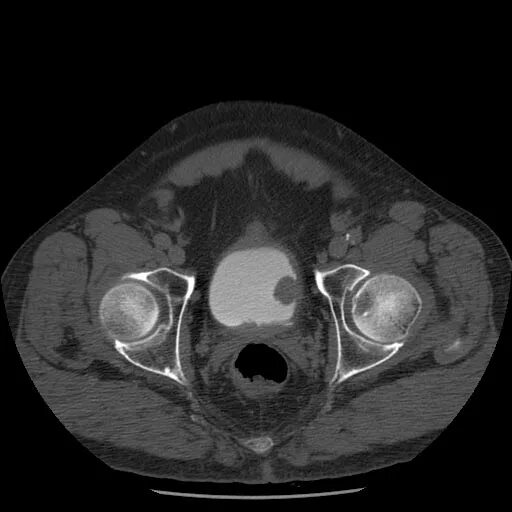 Опухоль мочевого пузыря мрт. Трабекулярный мочевой пузырь на кт. Опухоль мочевого пузыря на кт. Кальцинаты в мочевом пузыре на кт. На кт видно опухоль