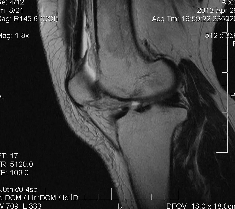 Замыкающие пластинки тел позвонков. Отёк костного мозга позвоночника l5 s1. Костный мозг бедренной кости. Мр сигнал от костного мозга. Инфаркт большеберцовой кости мрт.