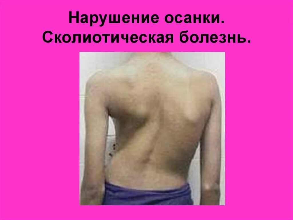 Нарушение осанки код. Нарушение осанки код