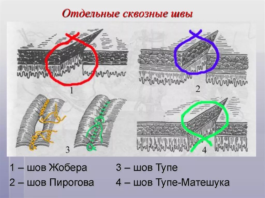 Стерильный шов. Кишечный шов Пирогова Матешука. Краевой Узловой шов Жобера. Сквозной краевой кишечный шов Жобера.