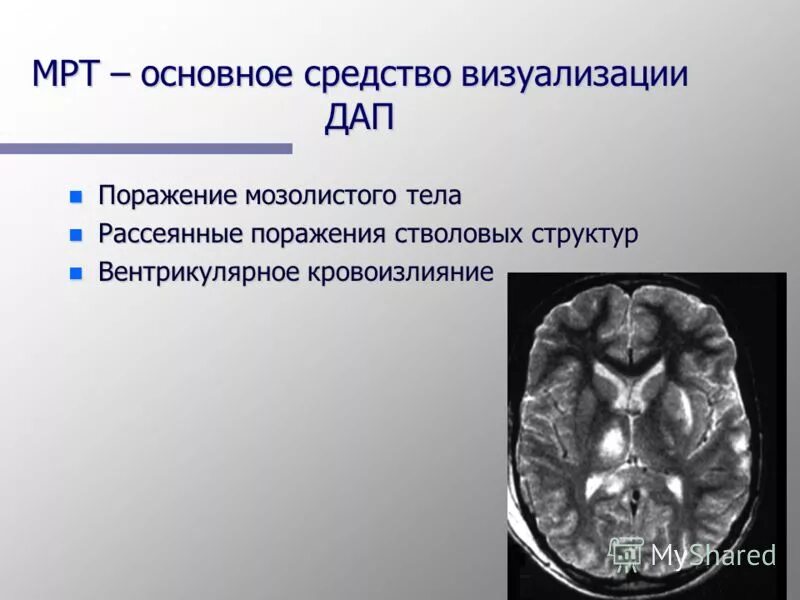 Диффузное аксональное повреждение кт. Диффузное поражение головного мозга на кт. Диффузное аксональное повреждение мрт. Диффузное аксональное повреждение головного мозга мрт. Диффузная травма