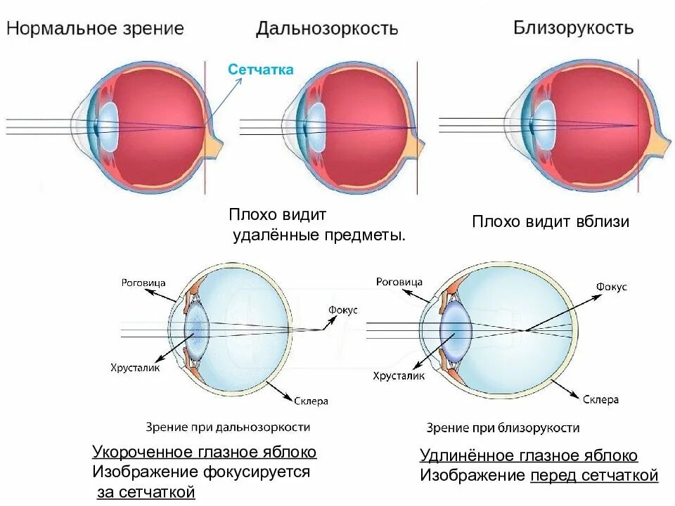 Дальнозоркость и близорукость строение глаза. Нормальное зрение близорукость дальнозоркость схема. Форма глазного яблока при миопии. Строение глаза дальнозоркость. Плохо вижу в линзах