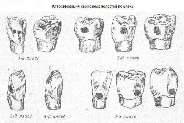 Пломбирование кариозных полостей 5 класса. Классификация кариозных полостей по блэку. классификация блэка кариес.