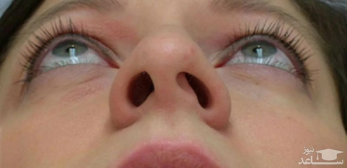 Искривление носовой перегородки мкб 10. Искривленная перегородка носа. Сильно сушит нос