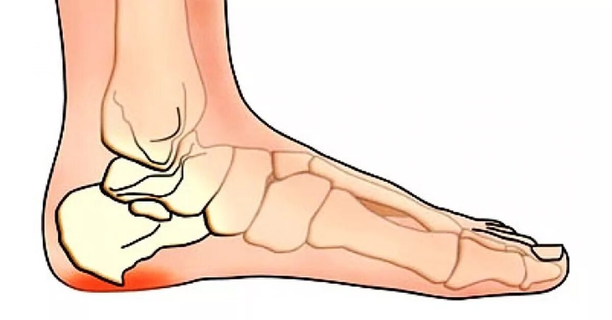 Сильно болят пятки при ходьбе. Плантарный фасциит рентген. Плантарный фасциит пяточной кости. Пяточно подошвенный фасциит.