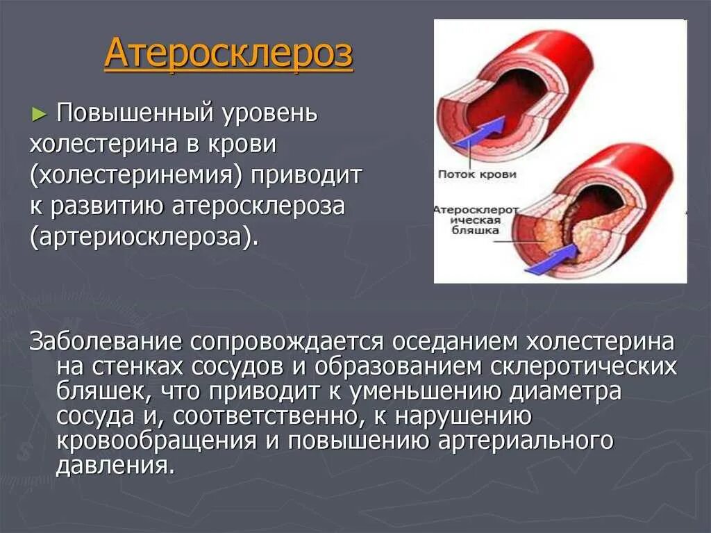 Атеросклероз сосудов ишемическая болезнь. Причины заболевания атеросклероза. Атеросклеротические изменения в артерии.