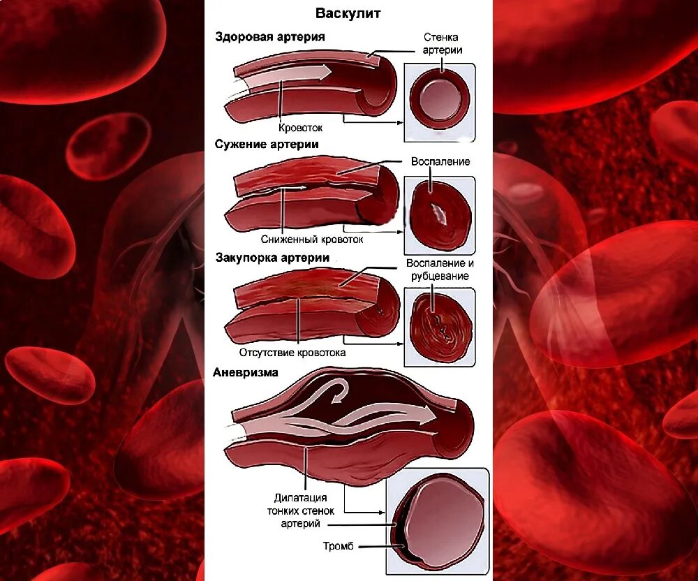 Воспаление всех вен латынь. Воспалительные поражения сосудов - васкулиты. Поражение мелких сосудов. Воспаление стенок сосудов.