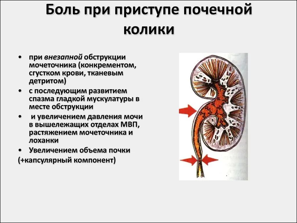 Боли в области мочеточника. Почечная колика. Острая почечная колика локализация боли. Спастические сокращения мочеточника.