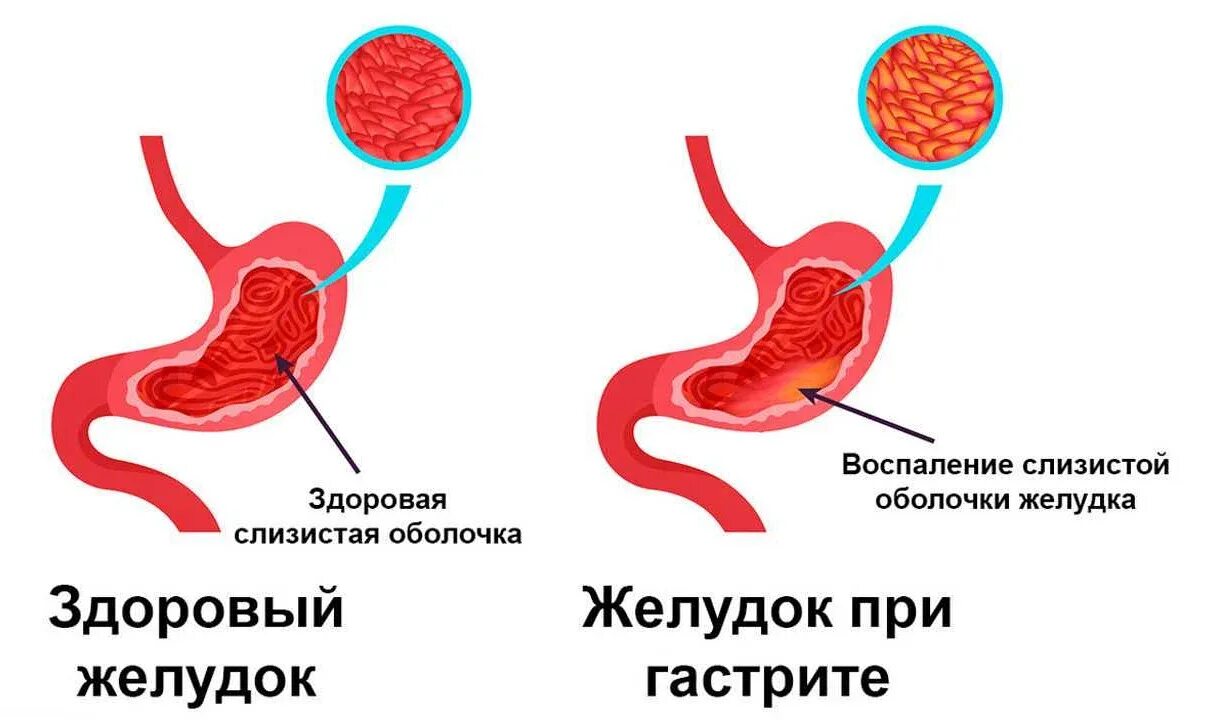 Как лечится гастрит желудка. Симптомы гастрита желудка. желудок с повышенной кислотностью. острый гастрит с повышенной кислотностью. кислотность желудка картинка.