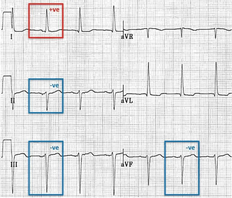 Отклонения параметров qrs avr. Lbbb экг это. выпадение комплекса qrs на экг. выпадает комплекс qrs на экг. узкий комплекс qrs на экг.