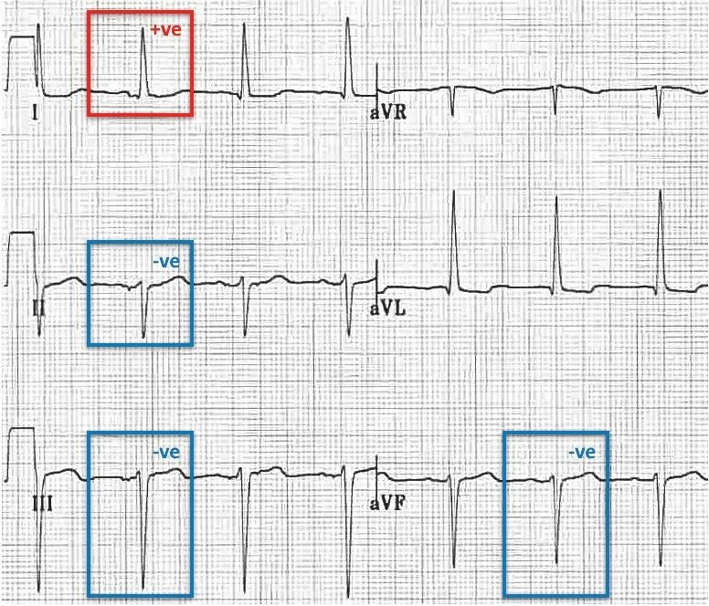 Qrs на экг что это. LBBB ЭКГ это. Выпадение комплекса QRS на ЭКГ. Узкий комплекс QRS на ЭКГ. Широкий QRS на ЭКГ.