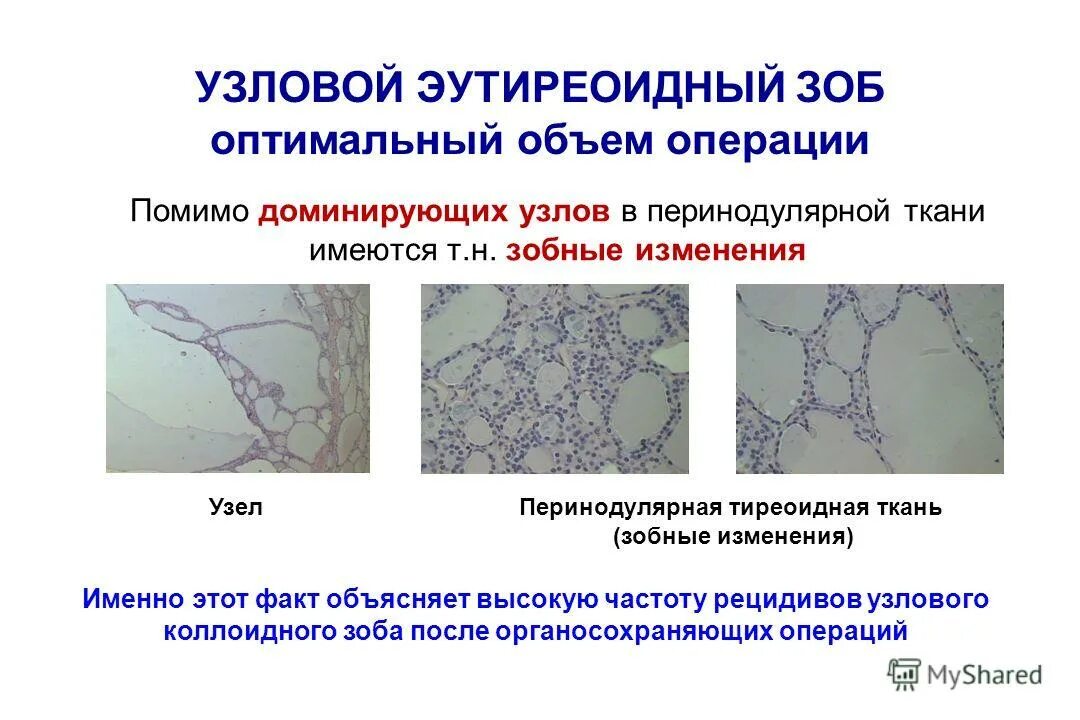 Коллоидный зоб. Многоузловой коллоидный зоб. многоузловой эутиреоидный зоб. коллоидный зоб гистология.