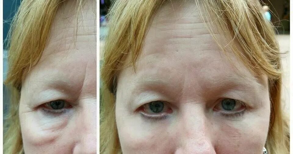Отекло лицо утром как убрать. Малярные мешки после ботокса. Ботокс под глаза до и после.