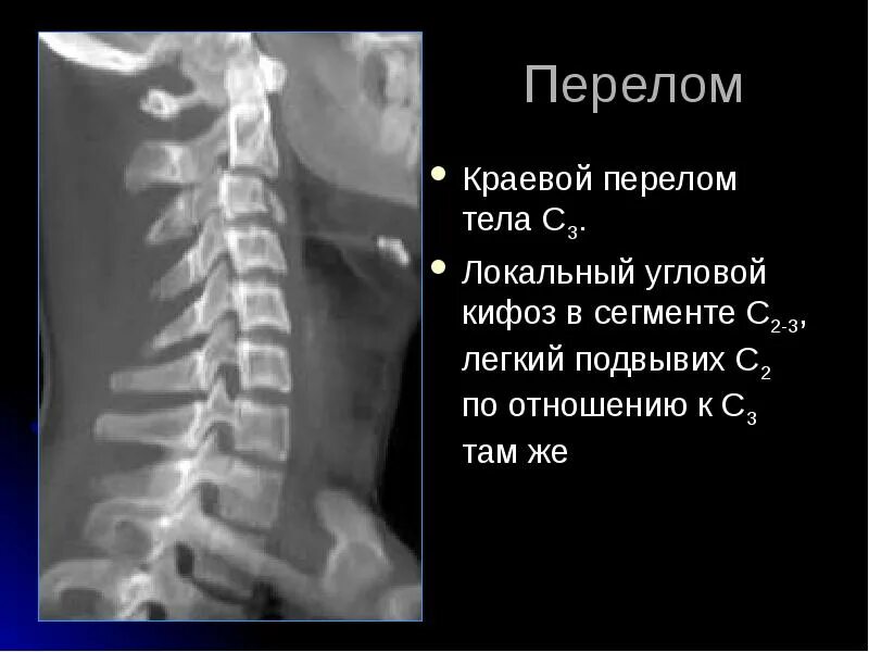 Перелом с1. Перелом с1. Перелом дужек позвонков рентген. Конкресценция с2-с3. Перелом с7 позвонка рентген.