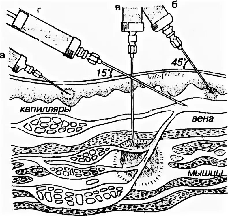 Внутрикожная инъекция угол введения иглы. Угол введения иглы при внутрикожной инъекции. Внутривенная инъекция техника угол иглы. Угол введения иглы при внутривенной инъекции.