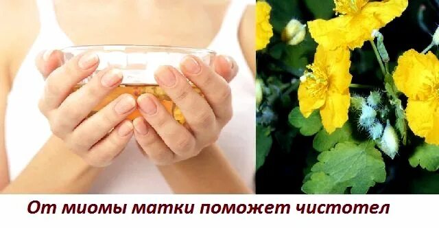 Чистотел от миомы. Чистотел от миомы матки. Спринцевание чистотелом. Чистотел для спринцевания в гинекологии.