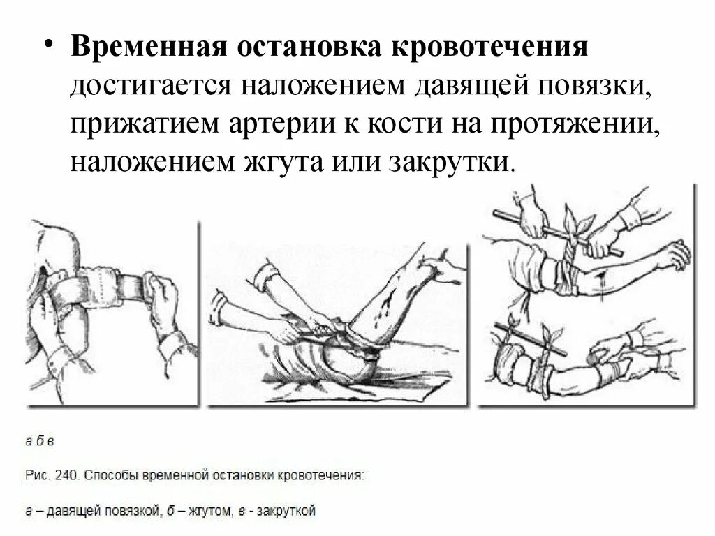 При каких кровотечениях необходимо наложить жгут. Наложение жгута при кровотечениях. Ошибки при наложении жгута при кровотечении. Наложение жгута и давящей повязки при кровотечениях. Остановка кровотечения жгутом.