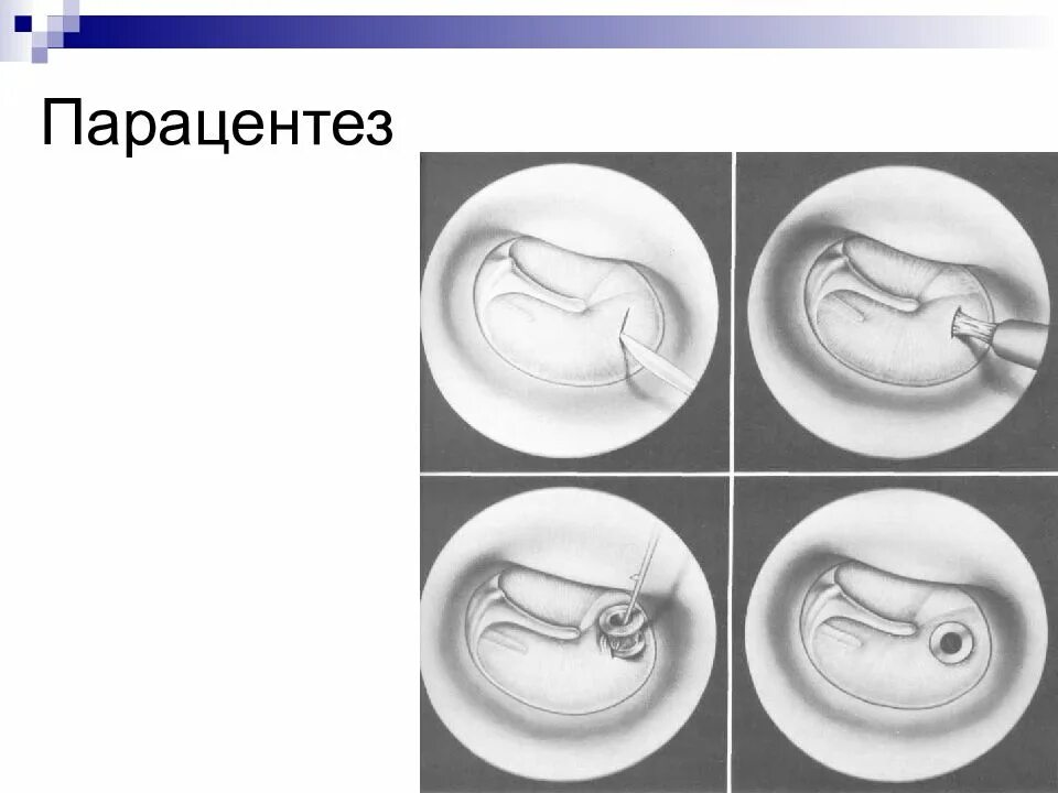 Парацентез барабанной перепонки это. Парацентез разрез барабанной перепонки. Парацентез барабанной перепонки техника. Парацентез уха реабилитация.