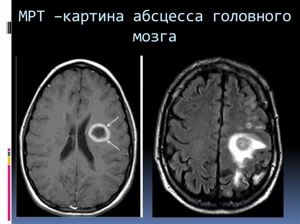 Абсцесс мозга. Отогенный абсцесс головного мозга. Кт при абсцессе головного мозга. Абсцесс головного мозга кт. Мрт абсцесса височной доли.