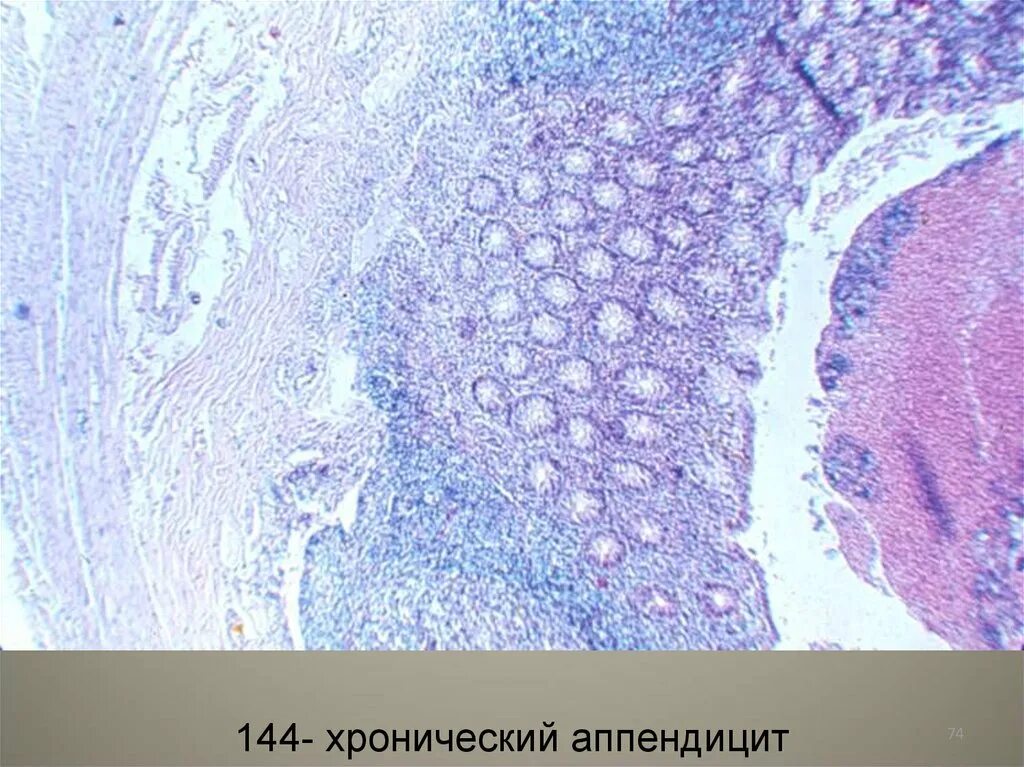 Флегмонозно язвенный аппендицит микропрепарат. Флегмонозный аппендицит Патан. Флегмонозно-язвенный аппендицит гистология. Хронический аппендицит гистология.