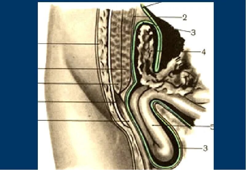 Левосторонняя косая паховая грыжа. Яичковая паховая грыжа. Паховый мешок. Осумкованная паховая грыжа. Паховый мешок.