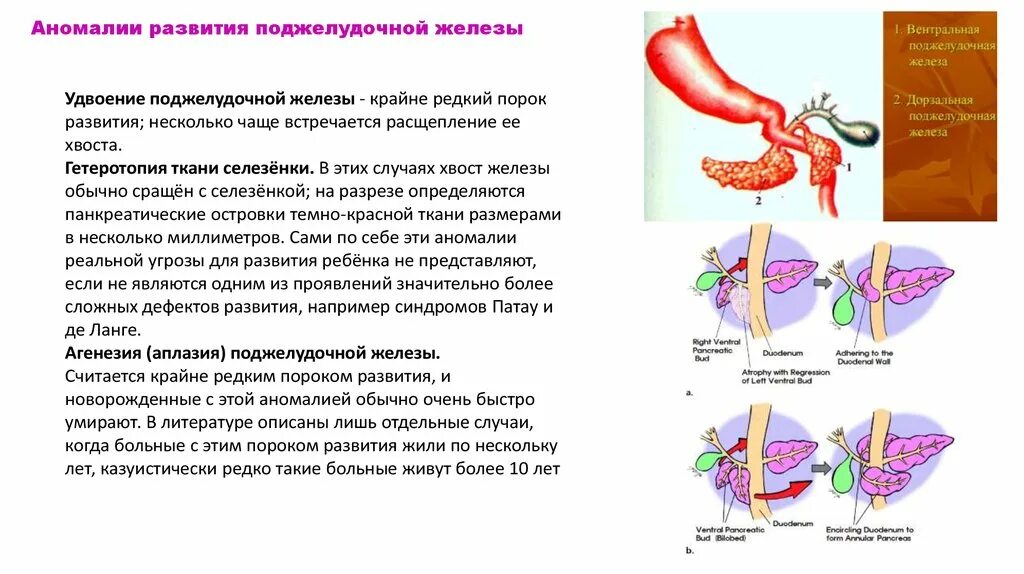 Поджелудочная железа операция отзывы. Аномалии развития поджелудочной железы. Недоразвитие поджелудочной железы. Порок развития поджелуд железы. Пороки развития печени и желчевыводящих путей.